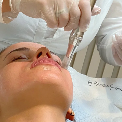 Microneedling Gesichtsbehandling